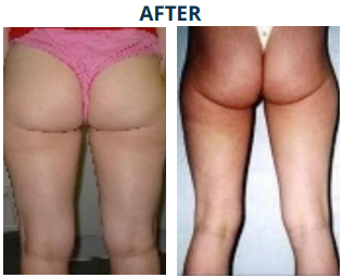 cellulite-after